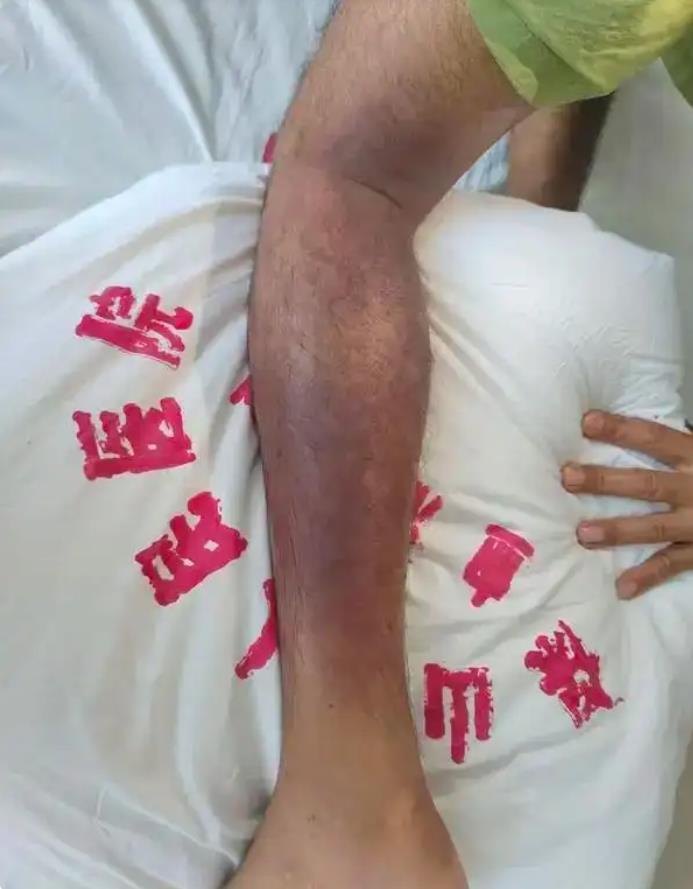 男子踩中蛇窝被毒蛇咬数口 休克昏迷 