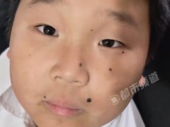 瞳孔地震具象化了！小男孩能控制瞳孔快速抖动